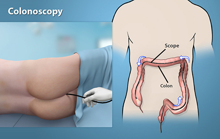 Endoscopy & Colonoscopy